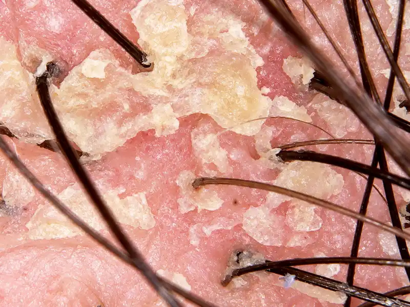 Dermatite seborreica indentificado pelo exame capilar